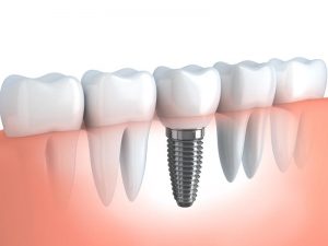 Ceramic Dental Implants